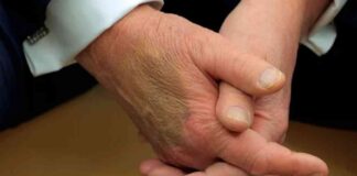 white-house-reveals-cause-of-trumps-mystery-bruise-meeting