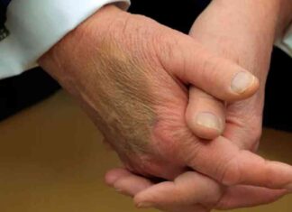 White House reveals cause of Trump’s mystery bruise meeting white-house-reveals-cause-of-trumps-mystery-bruise-meeting